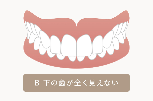 下の歯が全く見えない