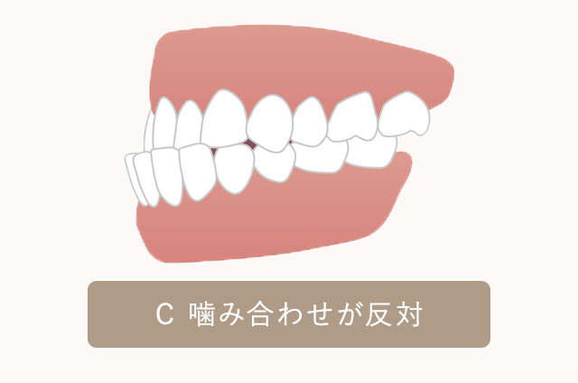 噛み合わせが反対