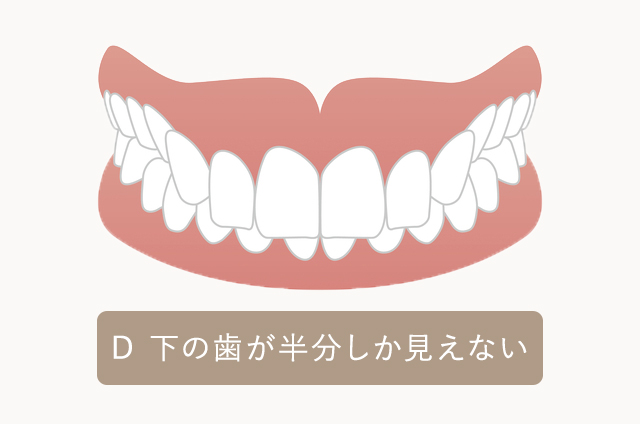下の歯が半分しか見えない