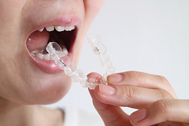 マウスピース型矯正「インビザライン」